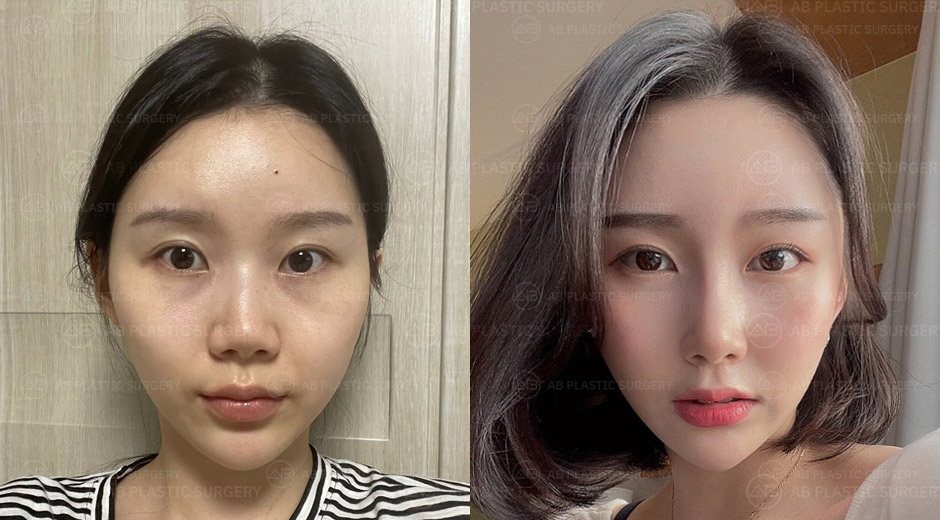 After double eyelid surgery, I don't have to wear heavy eye make up anymore.